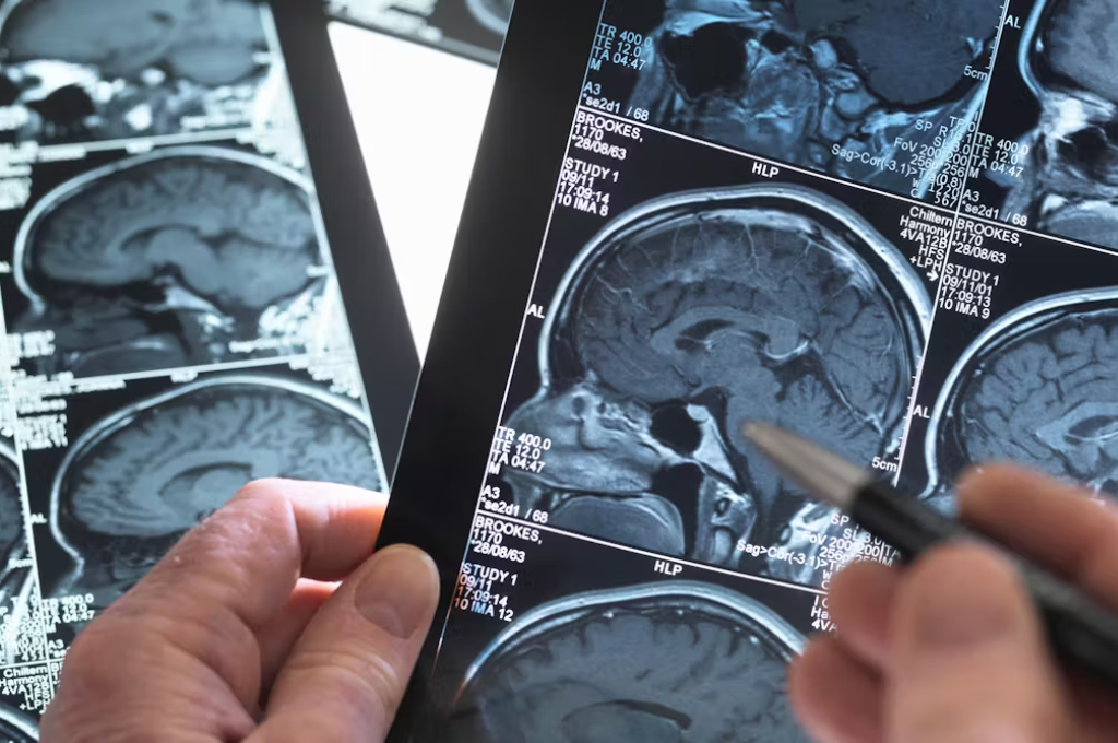 El cerebro cambia muy rápido en la mediana edad, y estudiarlo es clave para anticiparnos a la demencia